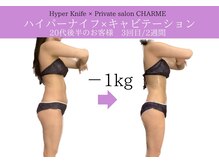 シャルム(charme)/部分的にも！ハイパーナイフ痩身