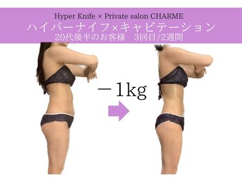 シャルム(charme)/部分的にも！ハイパーナイフ痩身