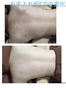 エクレクティック(ECLECTIC)/ハーブピーリング/背中エステ