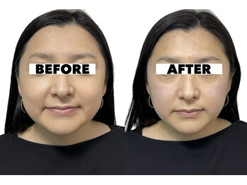 カドモリ 心斎橋(KADOMORI)/美容鍼1回【美容鍼/大阪美容鍼】