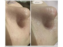 レア(le'a)/毛穴改善