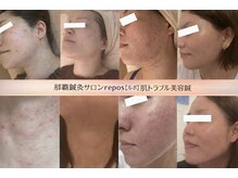 ルポ 那覇(repos)の雰囲気（【ニキビ/赤ニキビ/毛穴の黒ずみ・開き/大人ニキビ/顎ニキビ】）