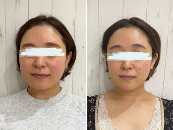 マキシフォート 名駅店(Maxifort)/小顔コルギ体験レポート