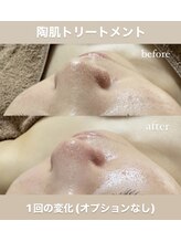 クレヴィー(Creviy)/陶肌トリートメント1回での変化