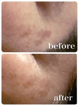 ブランシェ 金沢店 × 椿/シミケア『50代お客様』