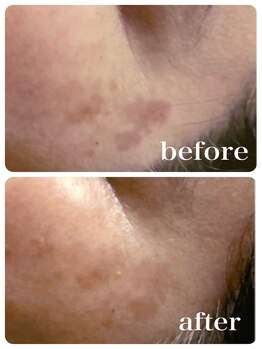 ブランシェ 金沢店 × 椿/シミケア『50代お客様』