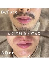 エピナ 横浜店(Epina)/メンズひげ脱毛/ヒゲ脱毛/髭脱毛