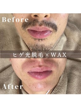 エピナ 横浜店(Epina)/メンズひげ脱毛/ヒゲ脱毛/髭脱毛