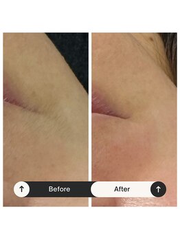 シュシュ(chou.chou)/フェイシャルWax【口まわり】