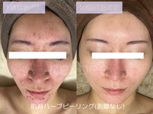 ハービー(Herbee)/剥離なしでも徐々にキレイに