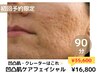 〈凹凸肌・毛穴の開き〉凹凸肌ケアフェイシャル90分