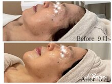 レ ベージュ(L’Beige)/リアボーテ肌質改善フェイシャル