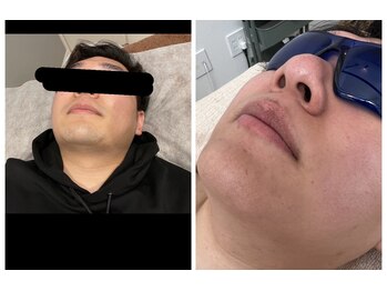 サロン ド マル(Salon de MARU)/ひげ６回経過