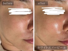 アムールサロン(Amour salon)/ホワイトスノーピール【新宿】