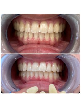 コナホワイトニング 神保町/ホワイトニング