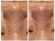 脱毛メリーの雰囲気(ハイドラ毛穴洗浄小鼻の黒ずみザラつき撃退)