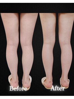 サンティエ(Santie)/むくみ、頑固なセル脂肪に