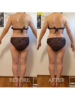 ブルーム(BLOOM)/施術1回でウエスト-2cm