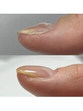 セラキュアネイル(Theracure nail)/爪の凹凸を緩和