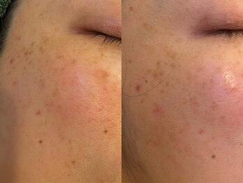 エヴェリーナ(Eveliiina)/38歳★1回シミケア