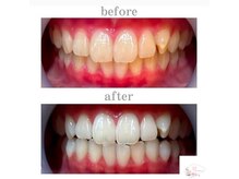 ホワイトニングショップ 本厚木店/【ビフォーアフター】10回