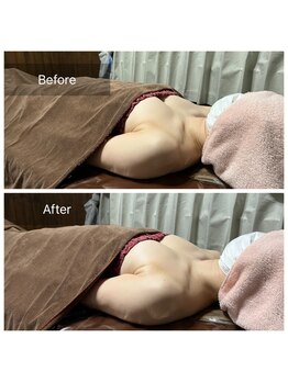 リノレア(LinoLea)/バストアップBefore after