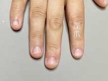 ニーヨンゼロ(240)/深爪