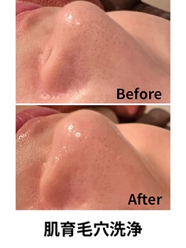 クラウン(CROWN)/毛穴洗浄　ビフォーアフター