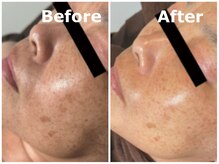 スイ 昭島店(Sui)/ホワイトスノーピール/シミ/美白