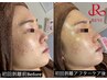 【夏前☆最速改善】認定講師施術☆剥離有りハーブピーリング￥33,000→￥19,800