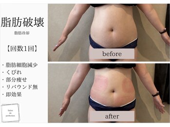 サロン ド パーフェクション(Salon de Perfection)/脂肪冷却