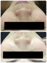 メイユール(MEILLEUR)/光フェイシャル24回