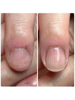 男性の深爪ネイルサロン