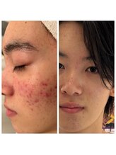 サワコウボウ セラピー(SAWAKOBO therapy)/2Bバイオ10代男性施術経過