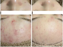 アン(anne)/剥離なしハーバルメソッド×10回