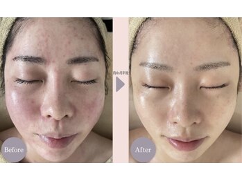 リノア 堀江(Linoa)/大人気◎ニキビケアコース