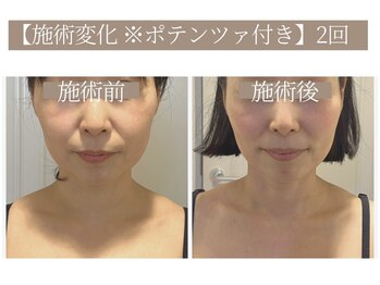 ドクターボディ 恵比寿店(Dr.Body)/【たるみ/小鼻縮小 50代】