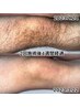 【men's】夏だからこそ今！清潔感激UP！すね毛、太もも 脚全体脱毛★