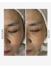 ケアラ(Care.A)/シミもたるみもお任せ☆