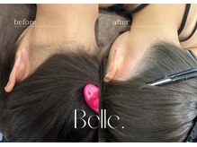 ベル(Belle)/【症例】お子様7歳から脱毛