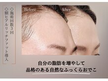 ベラ 東京院(Bella)/エステで上品ふっくらおでこ