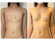 モア(moa)/たった2回でこの変化！