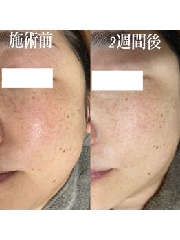 コリー(Kolly)/シミケア