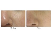 ベルーナビューティ 西新宿(Beluna beauty)/GRACE PEEL ビフォーアフター