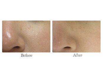 ベルーナビューティ 西新宿(Beluna beauty)/GRACE PEEL ビフォーアフター