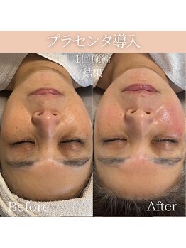 リフィール(Re:feel)/プラセンタ美容液導入