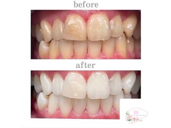 ホワイトニングショップ 本厚木店/【ビフォーアフター】10回