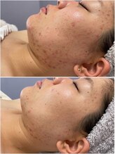 いおり骨盤整体 リブート(RE:BOOT)/ハーブピーリング