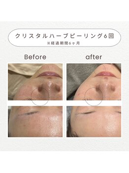 ノドカ 新市街店(NODOKA)/色素の沈着・くすみのケアに