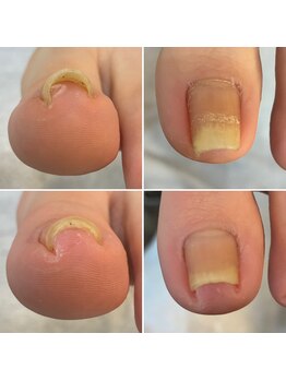 巻き爪カット、得意です！